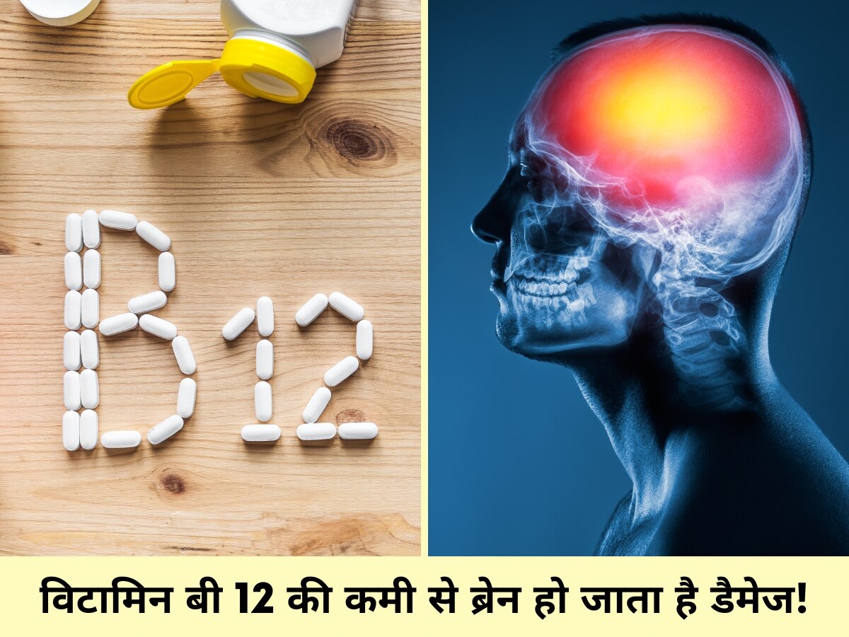 Vitamin B12 Deficiency: दिमाग को डैमेज कर देती है विटामिन बी 12 की कमी, जा भी सकती है जान!