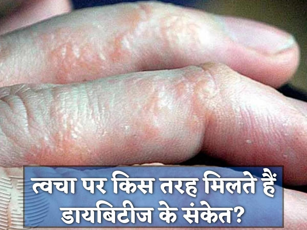 Diabetes Symptoms: त्वचा से भी मिलते हैं डायबिटीज के संकेत, इन 7 लक्षणों को न करना नजरअंदाज