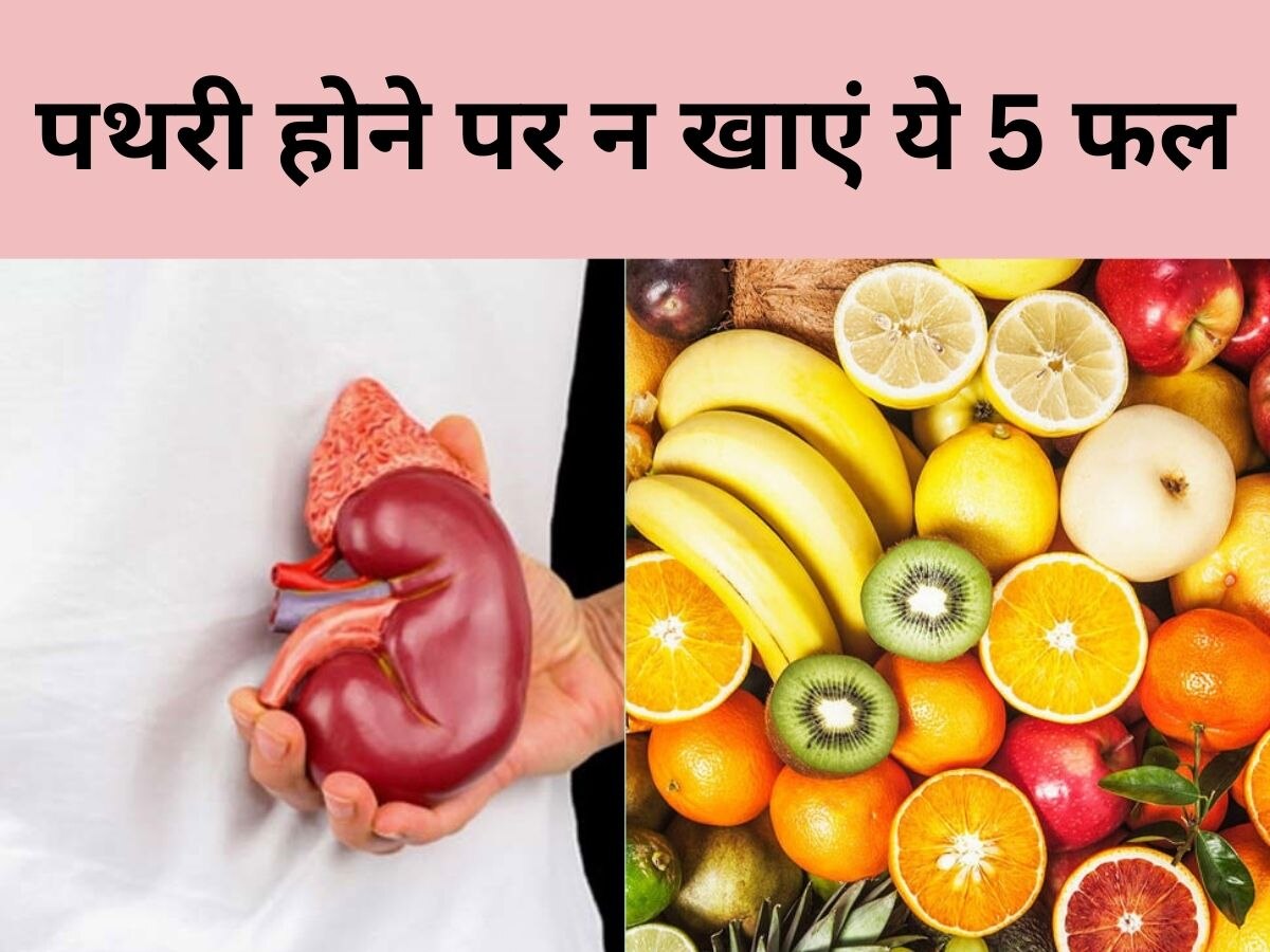 Kidney Stone होने पर गलती से भी न खाएं ये 5 फल, कहीं बढ़ न जाए गुर्दे में तकलीफ