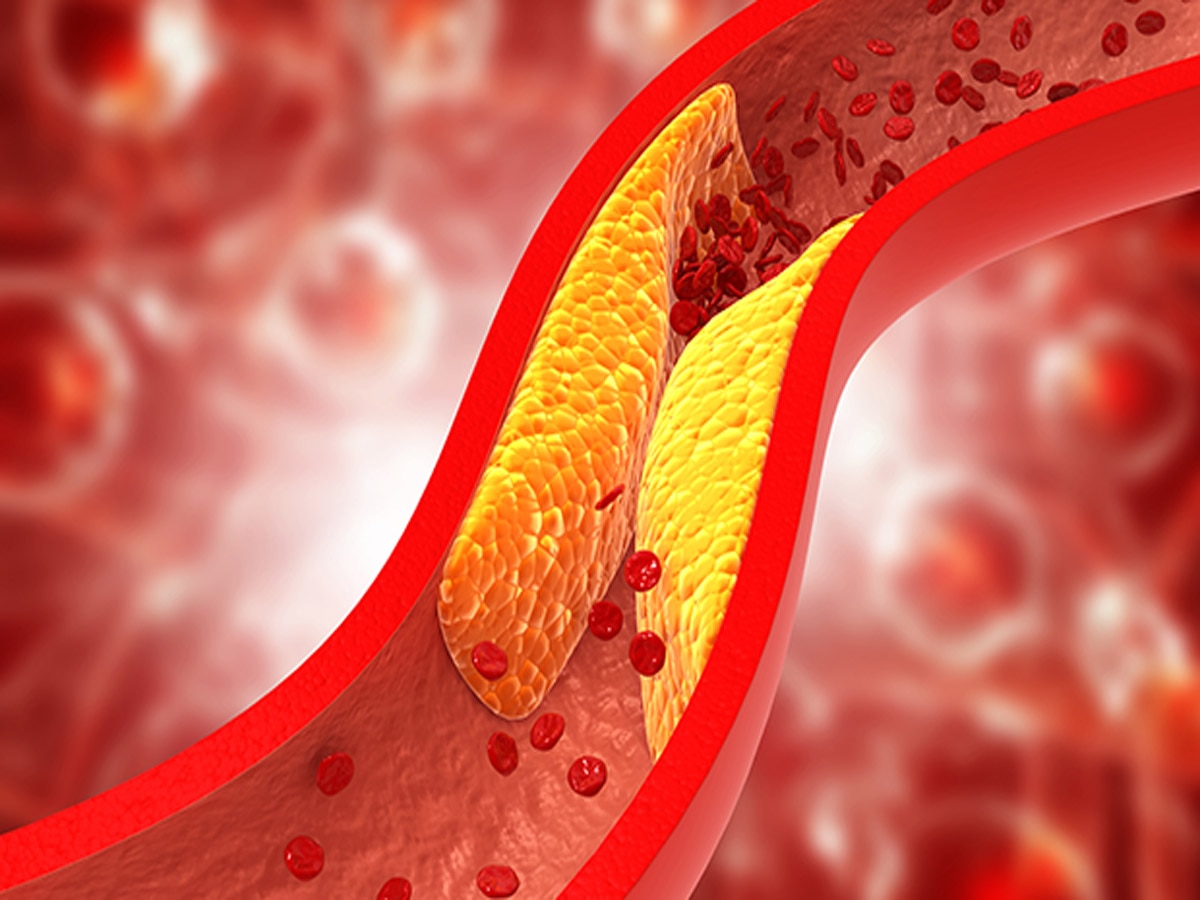 Cholesterol: चंद दिनों में लेवल में आ जाएगा कोलेस्ट्रॉल, बस कर लें ये पांच आसान काम