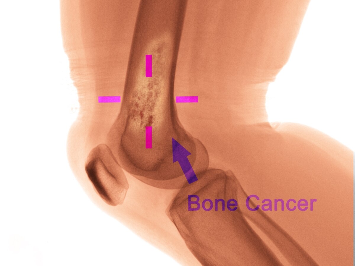 Bone Cancer Symptoms: किस कारण हड्डियों में होता है कैंसर? शुरुआती चरण में इस तरह मिलते हैं संकेत