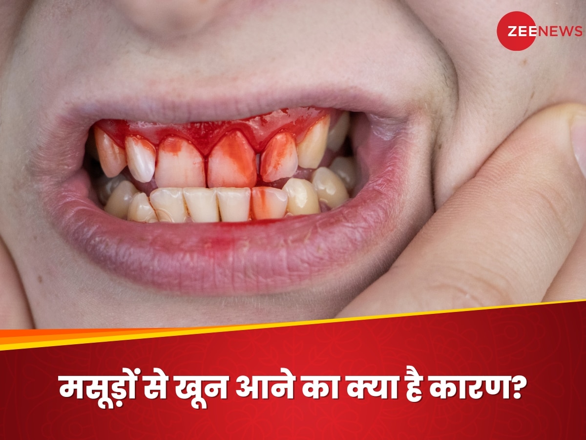 Bleeding Gums: इस विटामिन की कमी से मसूड़ों से आने लगता है खून, आज से ही खाना शुरू करें ये 5 फूड