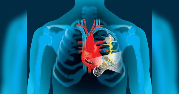 What is the difference between MRI pacemaker and non MRI pacemaker know ...