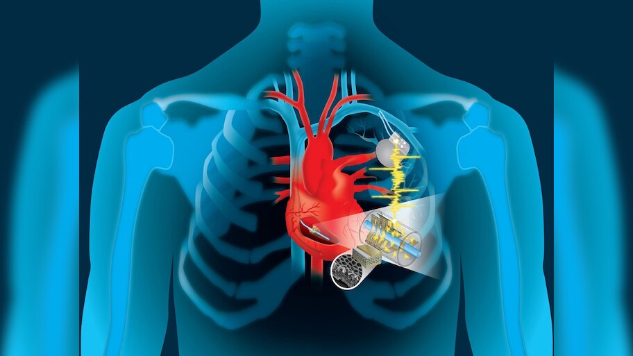 What is the difference between MRI pacemaker and non MRI pacemaker know ...