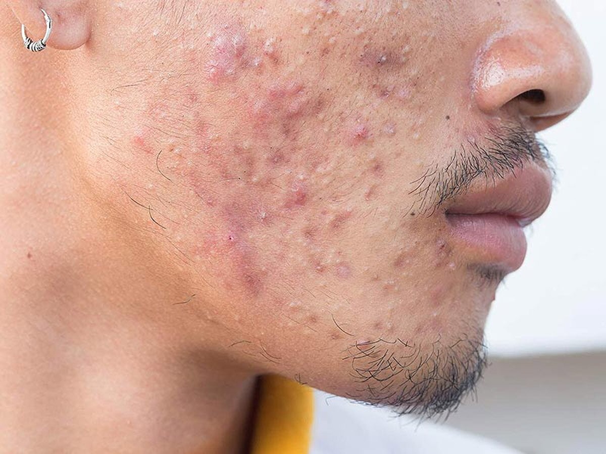 Acne Problem: करनी होंगी ये आसान चीजें, जड़ से खत्म हो जाएगी एक्ने की समस्या