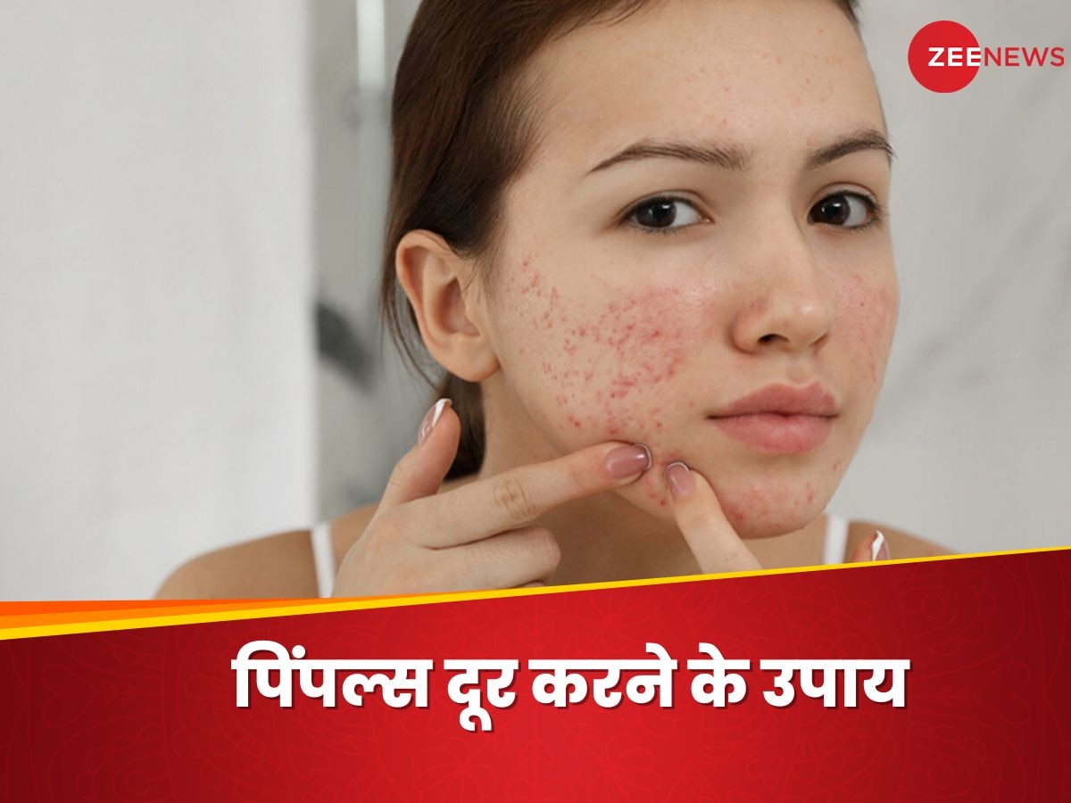 Pimples: चेहरे की खूबसूरती को बिगाड़ रहे हैं मुहांसे, घर में करें ऐसे 5 उपाय, जल्द होगा फायदा