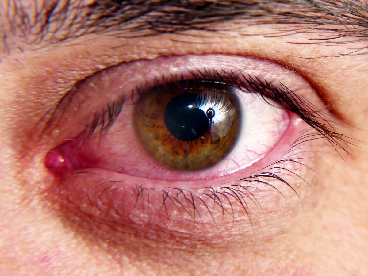 Dry Eye Disease: सर्दियों में बढ़ जाती हैं ड्राई आई की समस्या, जानिए कैसे करें आंखों की देखभाल