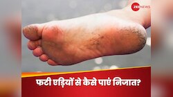 Cracked Heels: फटी एड़ियों के कारण बिगड़ रही पैरों की खूबसूरती, ऐसे पाएं मुलायम पांव