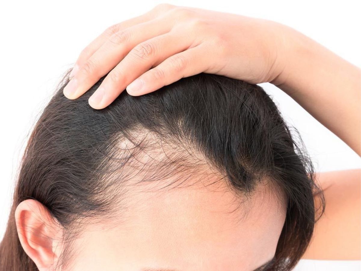 किस विटामिन की कमी से बाल पतले होते हैं? इन 3 घरेलू उपायों से बालों को बनाएं घना
