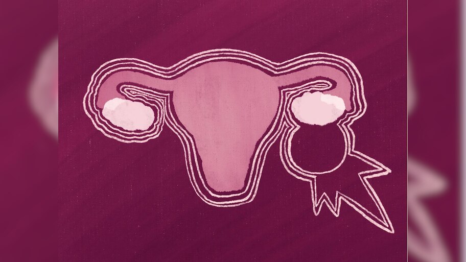 Uterus cysts causes symptoms effcts on fertility rasoli ke karan ...