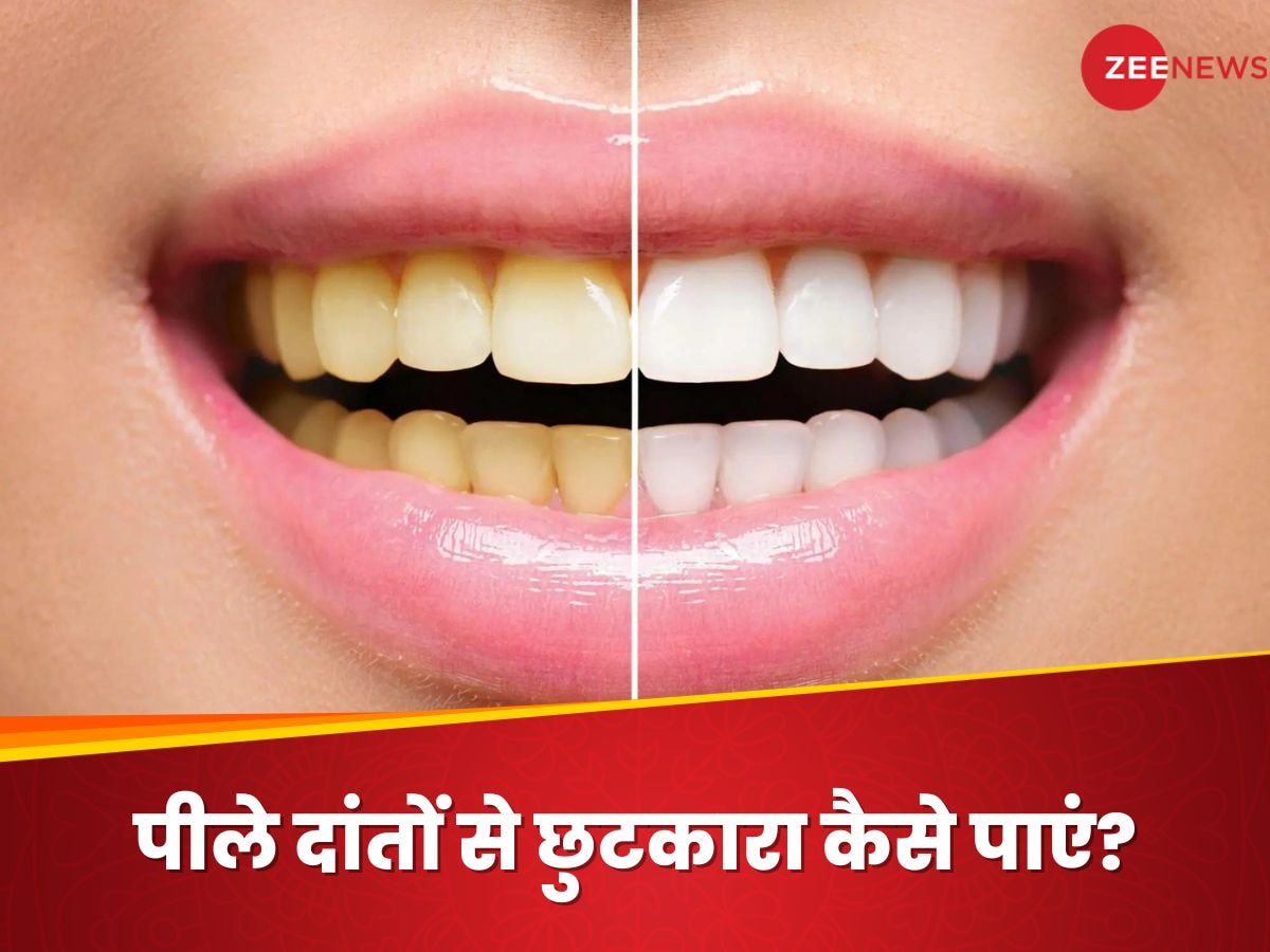 Teeth Whitening: क्या पीले दांतों ने छीन ली है आपकी मुस्कान? अपनाएं ये देसी नुस्खा, नेचुरली चमक उठेंगे दांत
