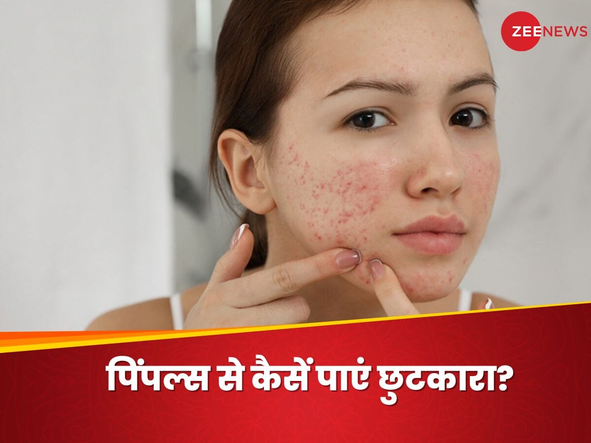 Pimples: जिद्दी पिंपल्स बिगाड़ रहे हैं चेहरे की खूबसूरती? इस तरह पाएं मुंहासों से निजात