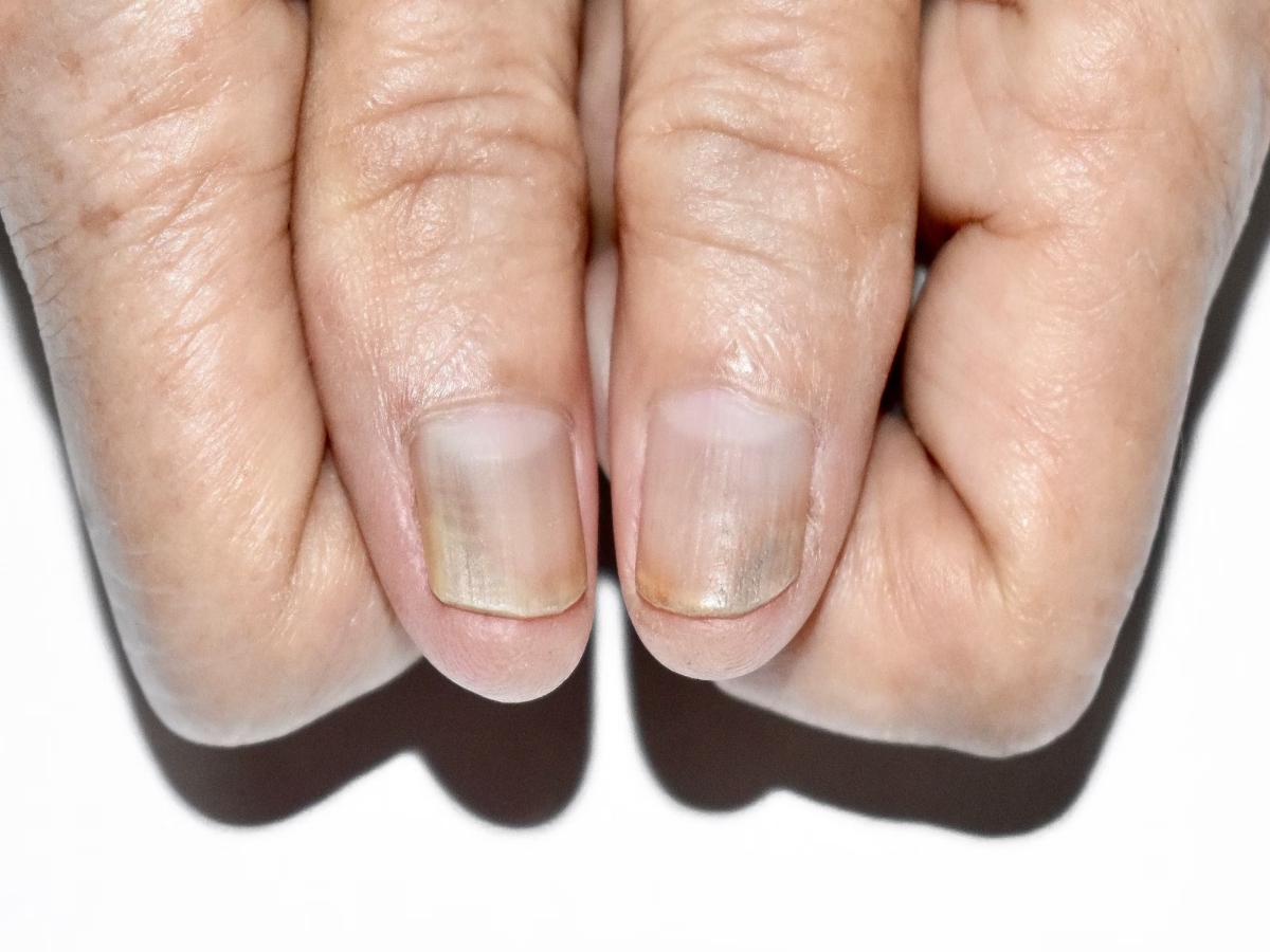 नाखूनों से जुड़ी समस्याएं