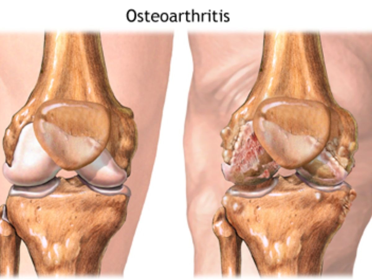 ऑस्टियोआर्थराइटिस