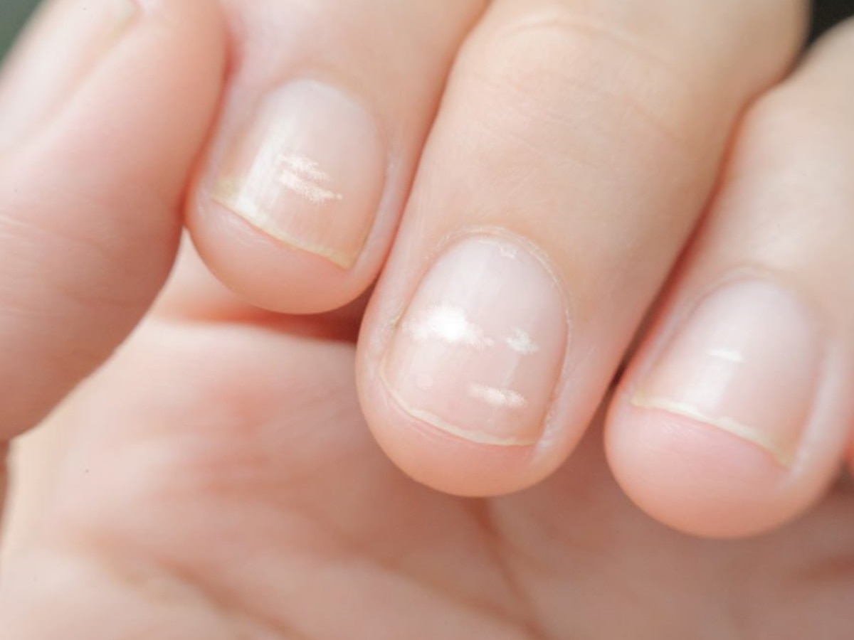 Nail Care Tips: नाखूनों में मौजूद सफेद दाग को बिल्कुल न लें हल्के, समय रहते इस तरह से करें देखभाल