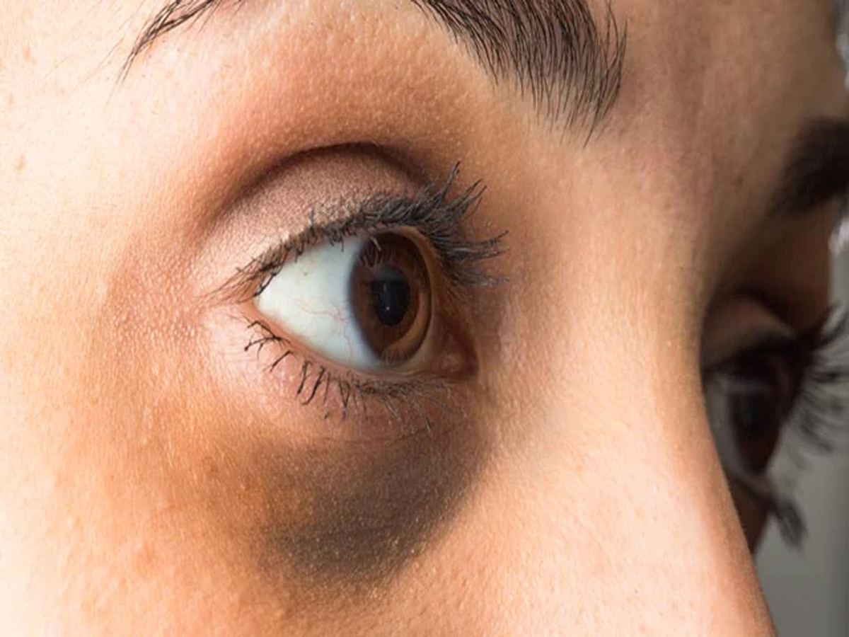 Under Eye Pigmentation: चंद दिनों में गायब हो जाएंगे आंखों के काले घेरे, बस ये तीन चीजों का करें इस्तेमाल