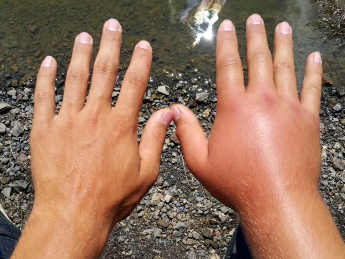 ठंड में रोजाना खाएं इस 1 चीज का लड्डू, शरीर को मिलेगी भरपूर एनर्जी... 16 हाथ पैरों में सूजन