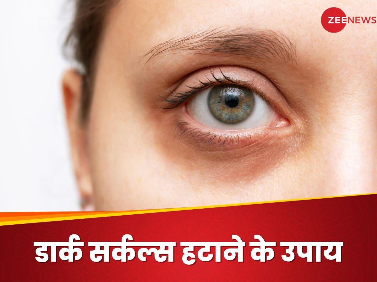 Dark Circles Removal: घर में आलू से बनाएं अंडरआई मास्क, हफ्ते भर में गायब हो जाएंगे डार्क सर्कल्स