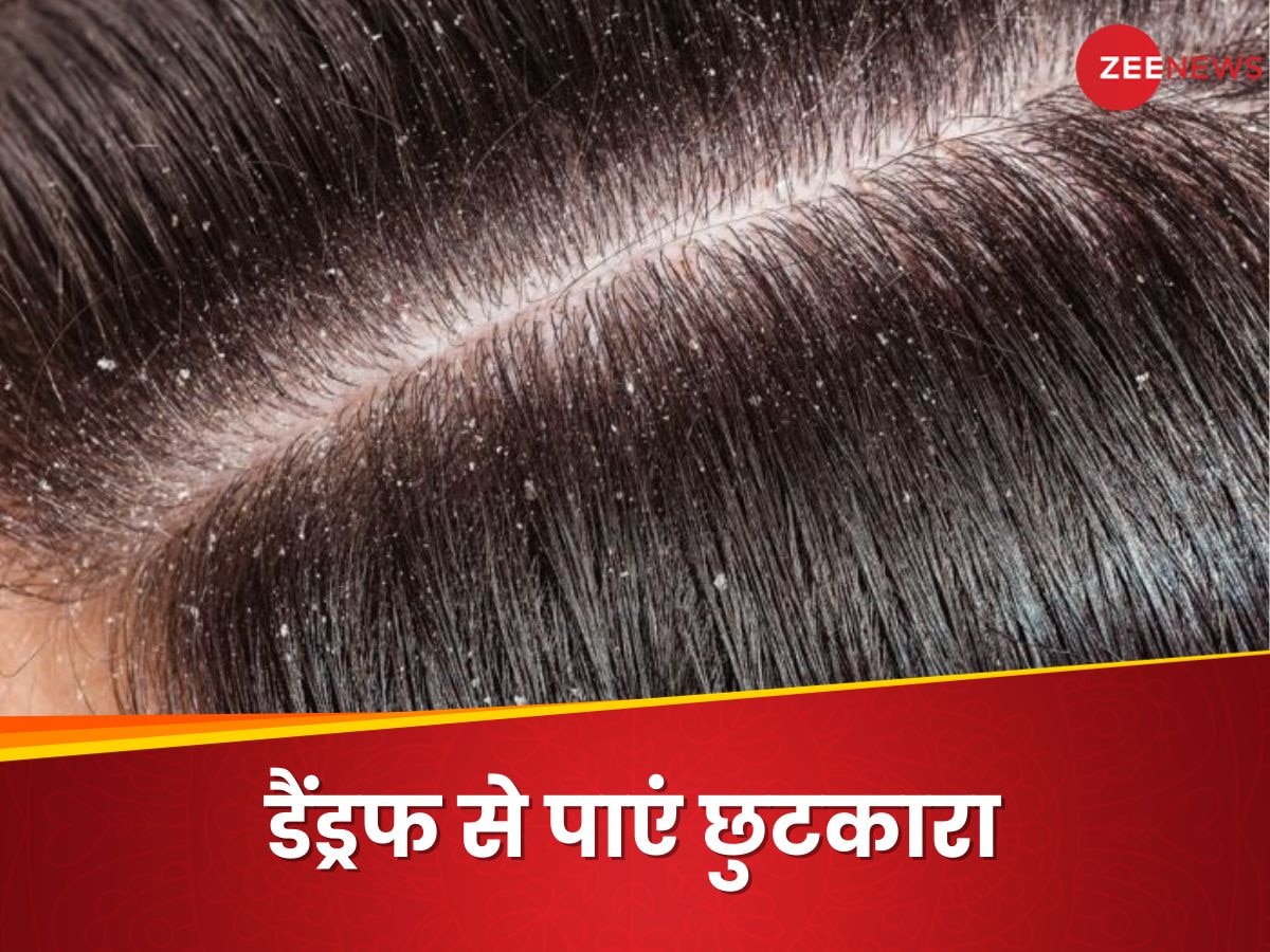 Dandruff Home remedies: डैंड्रफ से हैं परेशान तो इस घरेलू नुस्खे पाएं छुटकारा