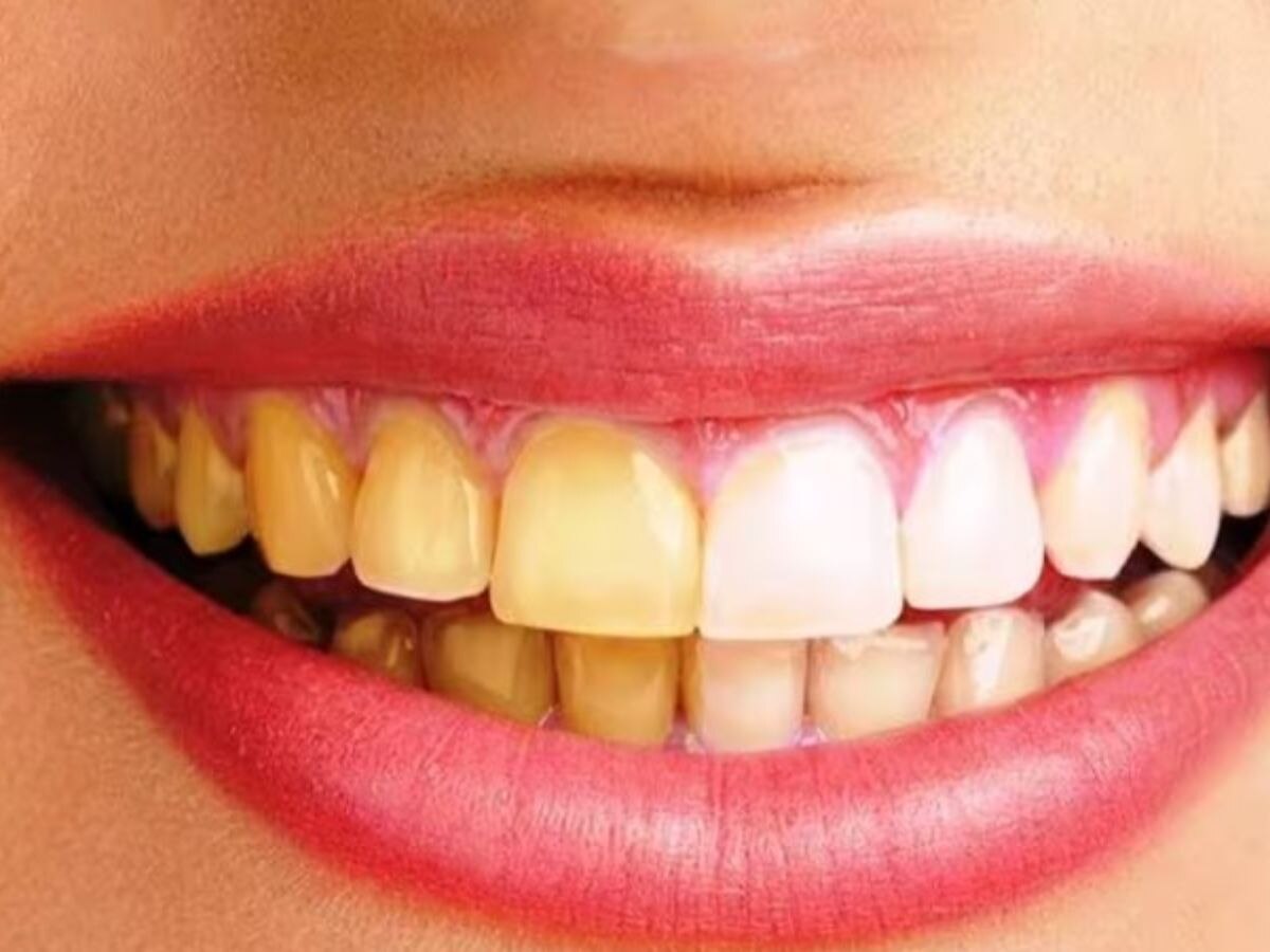 home remedies to clean yellow teeth danto ke pile pan ka ilaj in hindi