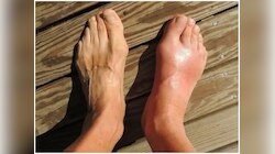 Uric Acid को कंट्रोल करने में मदद करेगी यह 5 चीजें, होगा गजब का फायदा