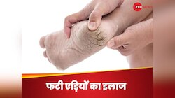 Cracked Heels: फटी एड़ियों को कहें अलविदा, ये 4 घरेलू नुस्खे देंगे रामबाण इलाज