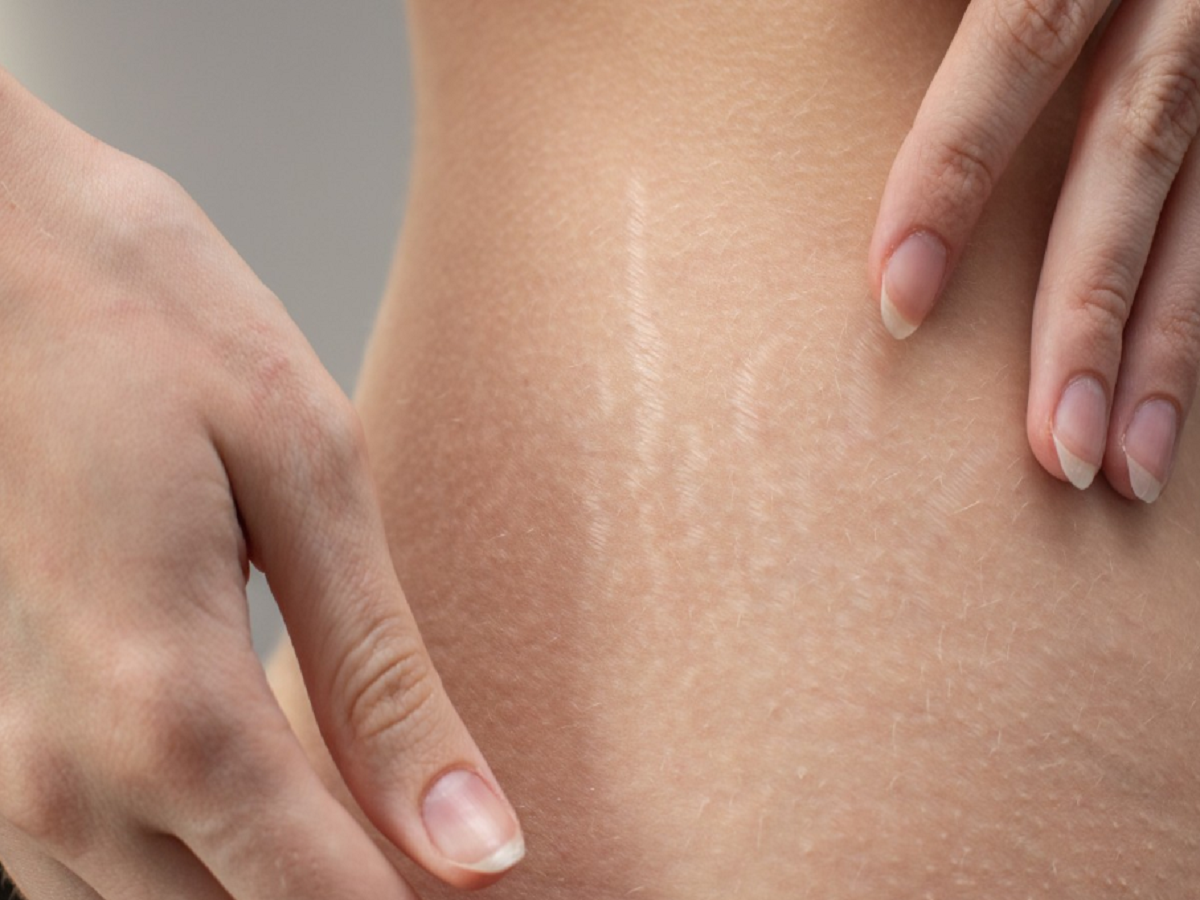 Stretch Mark:ଷ୍ଟ୍ରେଚ ମାର୍କ ପାଇଁ ଚିନ୍ତିତ କି ? ଆପଣାନ୍ତୁ ଘରୋଇ ଉପଚାର Stretch Mark:ଷ୍ଟ୍ରେଚ ମାର୍କ ପାଇଁ ଚିନ୍ତିତ କି ? ଆପଣାନ୍ତୁ ଘରୋଇ ଉପଚାର
