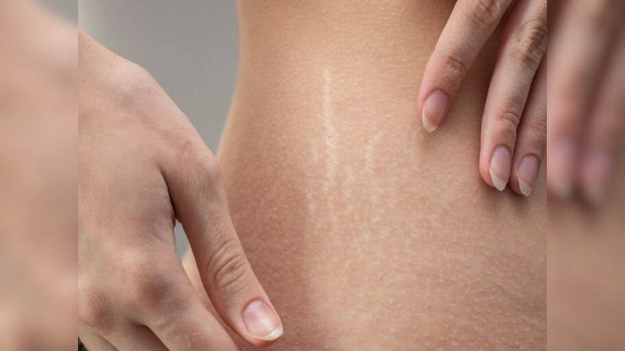 Stretch Mark:ଷ୍ଟ୍ରେଚ ମାର୍କ ପାଇଁ ଚିନ୍ତିତ କି ? ଆପଣାନ୍ତୁ ଘରୋଇ ଉପଚାର