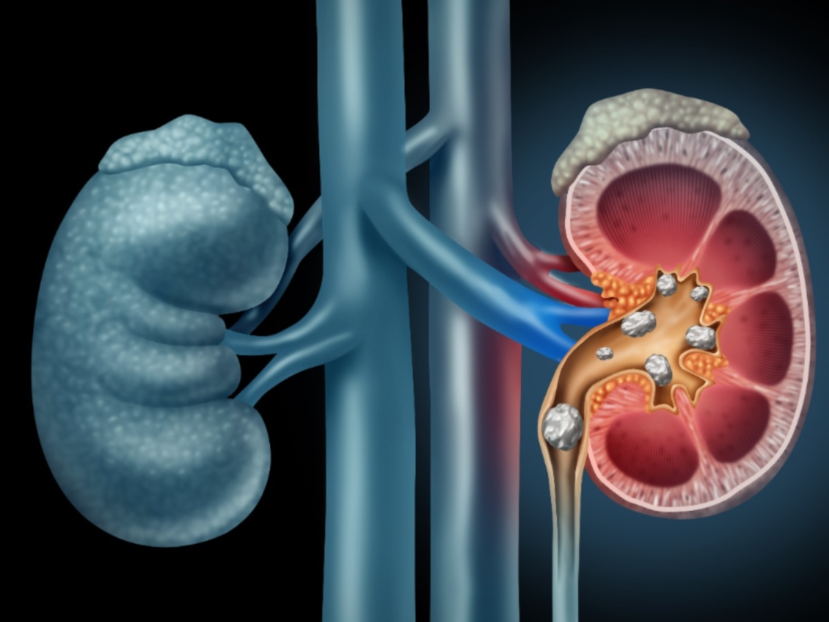 Kidney Stone Causes: किडनी में इस कारण से बनता है स्टोन, थोड़ी सी लापरवाही कर सकती है परेशानी  