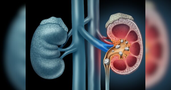 Kidney Stone Causes: किडनी में इस कारण से बनता है स्टोन, थोड़ी सी लापरवाही कर सकती है परेशानी