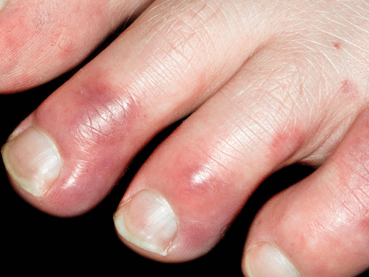 Swollen Fingers: सर्दियों में सूज गई हैं पैरों की उंगलियां तो घर बैठें ऐसे करें उपचार 