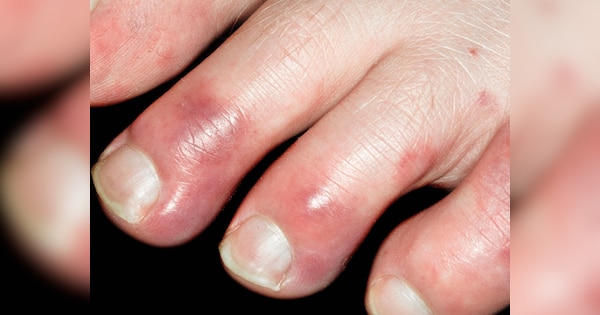 lifestyle-tips-home-remedies-to-cure-swollen-fingers-in-winter-season