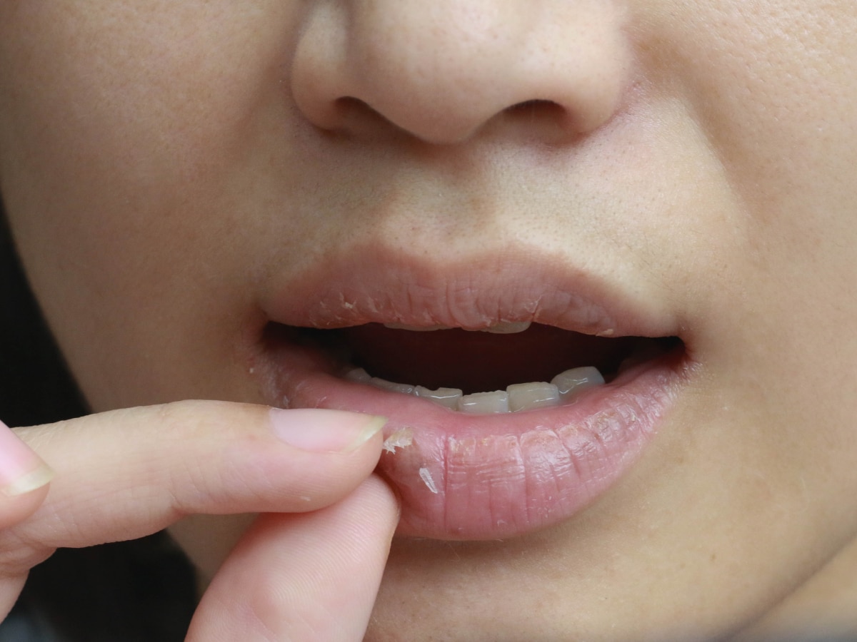 Reason for Cracked Lips: सर्दियों में क्यों फटते हैं होंठ? जानें कारण और बचाव के उपाय