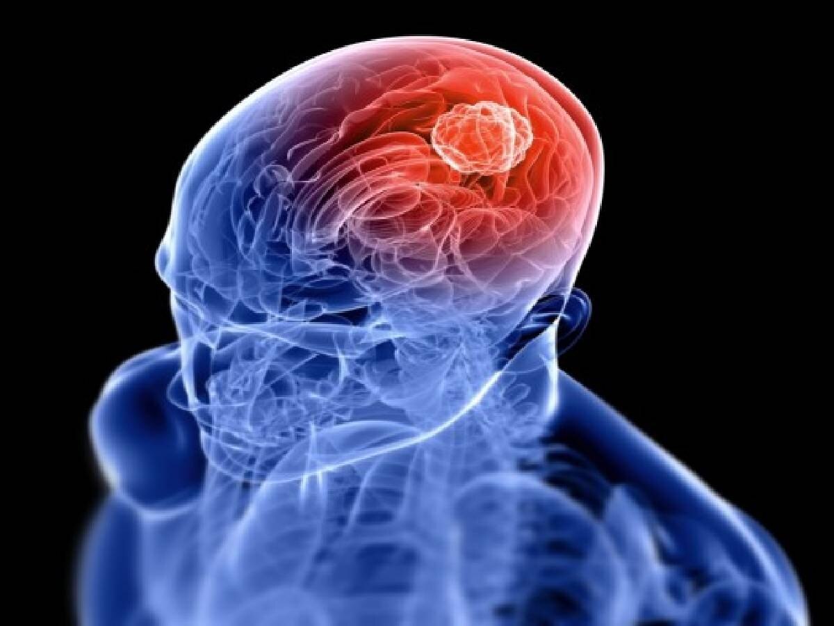 Brain Tumour Causes: इस कारण से हो सकती है ब्रेन ट्यूमर की समस्या 