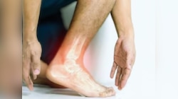 Uric Acid: यूरिक एसिड से हैं परेशान, इस तरह करें कंट्रोल 