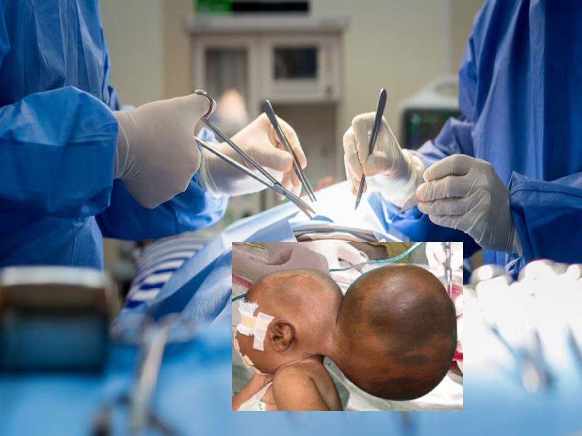 Jaipur sms hospital News : एसएमएस के डॉक्टरों ने ब्रेन से जुड़ी 2 किलो की निकाली गांठ, 5 माह की बच्ची को मिला नया जीवन