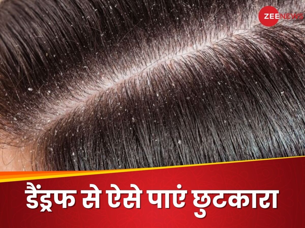 Home Remedies for Dandruff: डैंड्रफ से छुटकारा दिलाएंगे ये घरेलू उपाय, आज ही करें इस्तेमाल