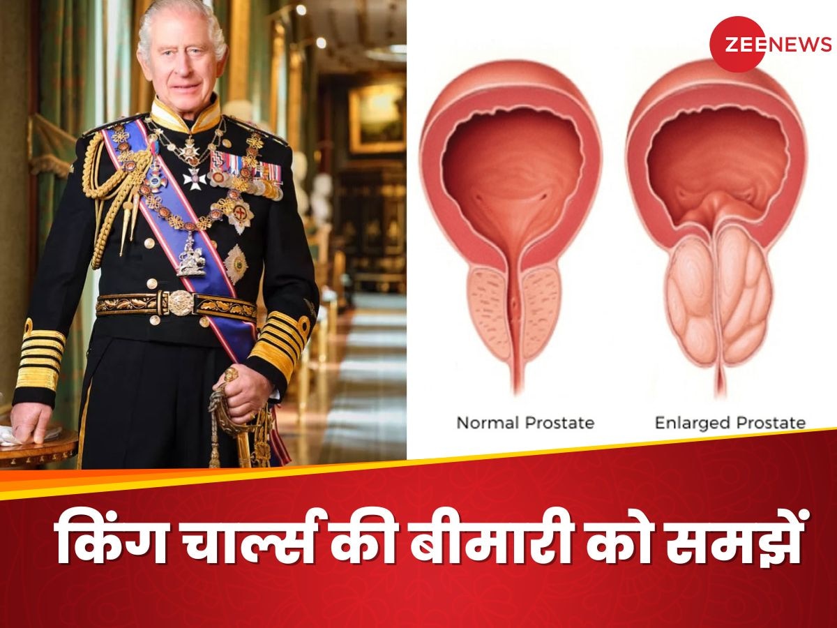 King Charles को हुई Enlarged Prostate की शिकायत, जानिए इस बीमारी को कैसे पहचानें