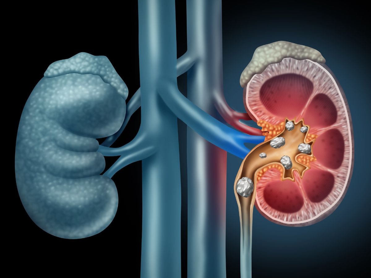Kidney Stone- किडनी की पथरी से जुड़ी 4 झूठी बातें, जो ले सकती हैं खतरनाक मोड़!