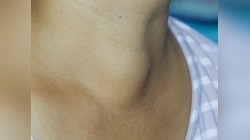 Thyroid Problem: थायराइड के हैं ये 4 कॉमन संकेत, भूल से न करें नजरअंदाज