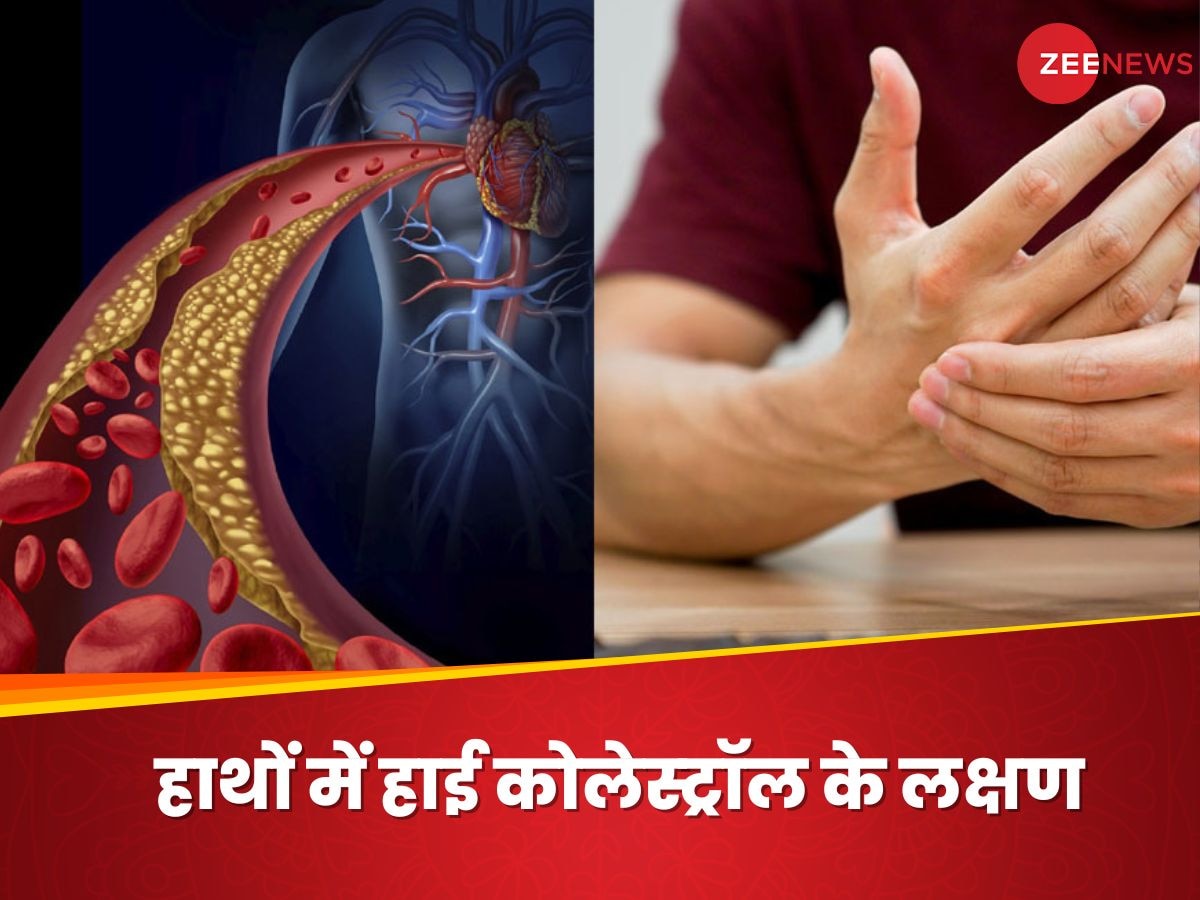 High Cholesterol: हाथों मे भी दिख सकते हैं हाई कोलेस्ट्रॉल के लक्षण, तुरंत पहचानें ऐसे इशारे