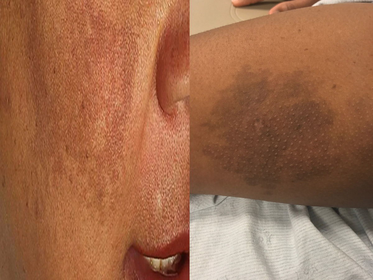 Hyperpigmentation: क्या होता है हाइपरपिग्मेंटेशन? जानें कारण, लक्षण और इसका इलाज Hyperpigmentation: क्या होता है हाइपरपिग्मेंटेशन? जानें कारण, लक्षण और इसका इलाज