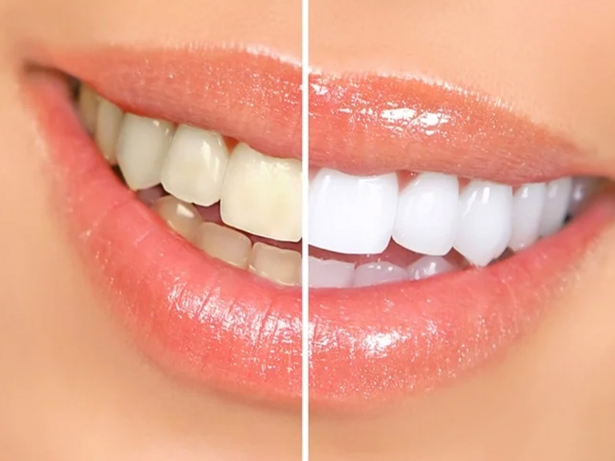 Yellow Teeth: क्यों होते हैं दांत पीले और कैसे करें इन्हें सफेद? पूरी डिटेल Yellow Teeth: क्यों होते हैं दांत पीले और कैसे करें इन्हें सफेद? पूरी डिटेल