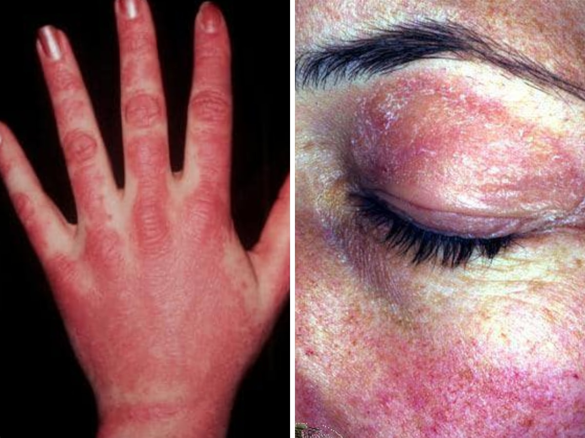 'Dermatomyositis' त्वचा में सूजन जैसे सामान्य लक्षण वाली ये बीमारी है जानलेवा, संकेतों को ना करें इग्नोर