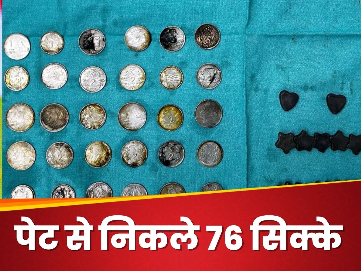 76 सिक्के पेट में लिए घूम रहा था शख्स, डॉक्टरों ने वजह पूछी तो पकड़ लिया माथा!