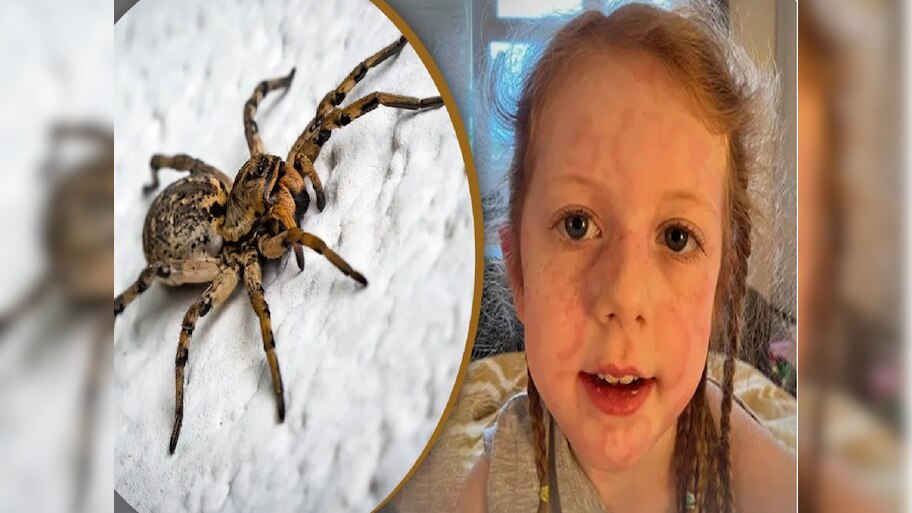 Spider bite:ବୁଢିଆଣି କାମୁଡ଼ାରେ ୫ ବର୍ଷ ଶିଶୁ ହରାଇଲା ଚାଲିବା ଶକ୍ତି !