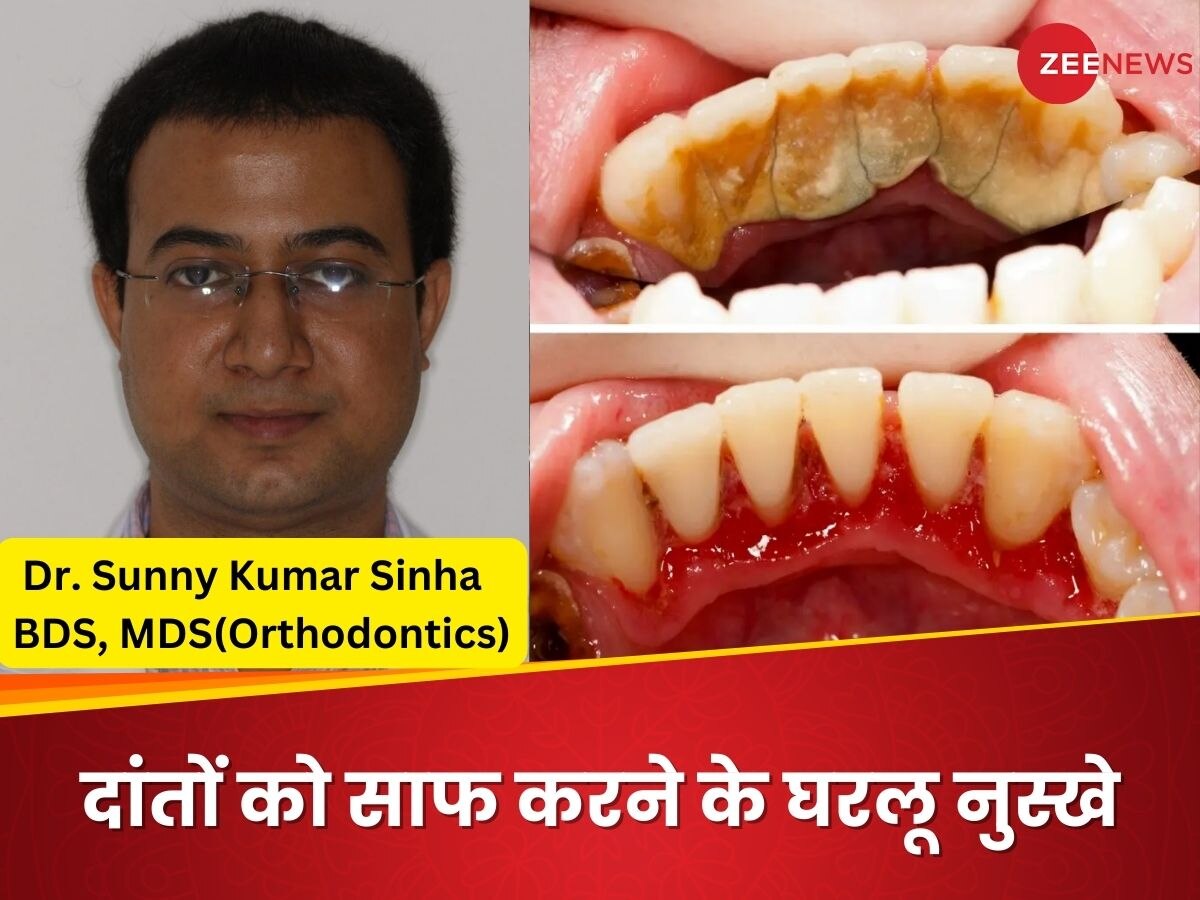 Teeth Cleaning: पीलेपन की वजह से छिन गई है दांतों की खूबसूरती? किचन की ये चीजें आ सकती हैं काम