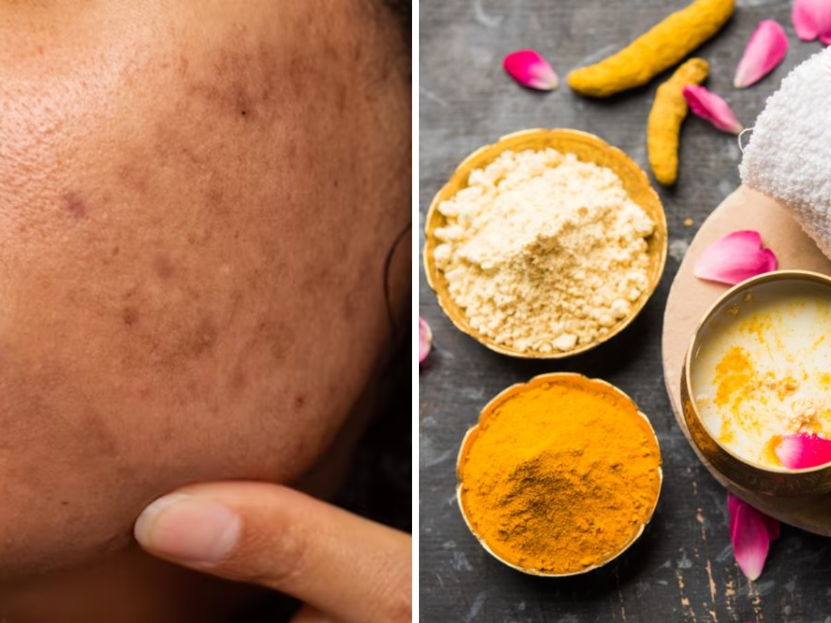 चेहरे की झाइयों को जड़ से खत्म कैसे करें? ये 5 Pigmentation के घरेलू नुस्खे कर सकते हैं मदद