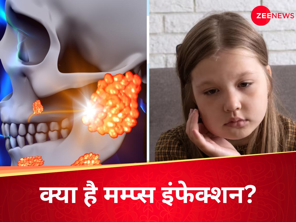 Mumps Symptoms: 1 दिन में 190 केस, केरल में फैल रही मम्प्स की खतरनाक बीमारी, गाल से लेकर ब्रेन तक में हो जाती है सूजन