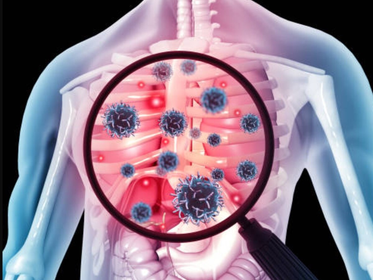 छींकने- खांसने ही नहीं बल्कि सांस लेने से भी फैल सकता है TB,नई स्टडी में हुआ खुलासा 